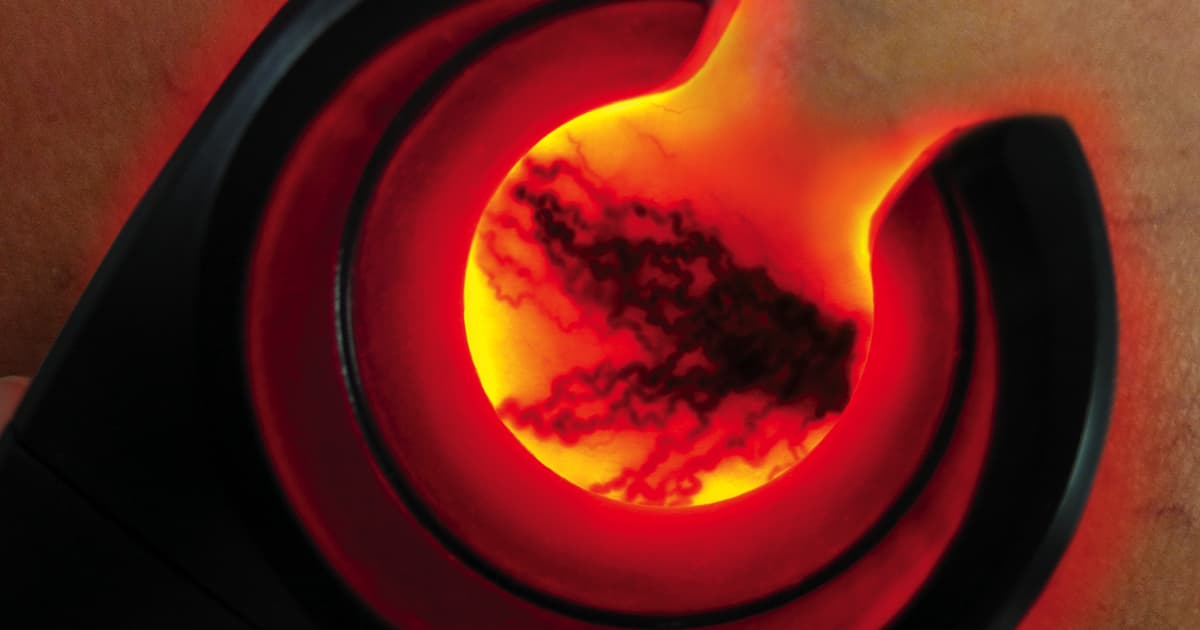 Transillumination and Veinlite®